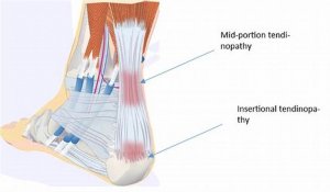 image: antaomy of the achilles tendon