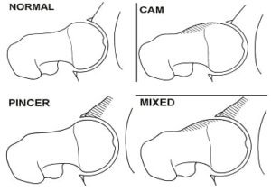 image: different types of hip impingement