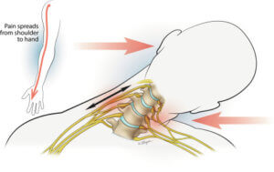 image of a neck bending sideways showing stinger injury