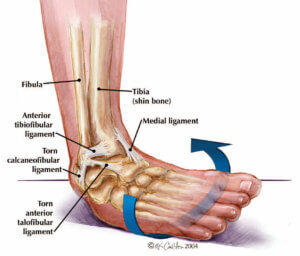 ankle inversion sprain