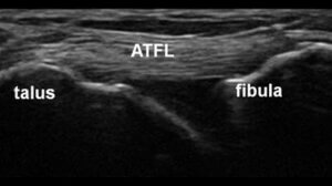 ATFL ultrasound