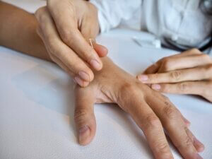 acupuncture on hand